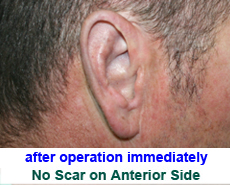 plastic-surgery-prominent-ear 